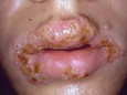 Bệnh Chlamydia ở miệng