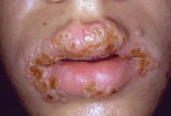 Bệnh Chlamydia ở miệng