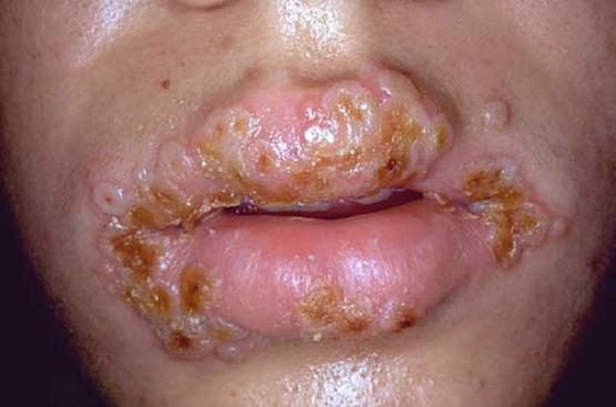 Phương pháp điều trị bệnh Chlamydia ở miệng hiệu quả nhất