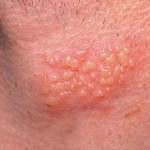 Bệnh herpes trên da
