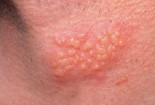 Bệnh herpes trên da
