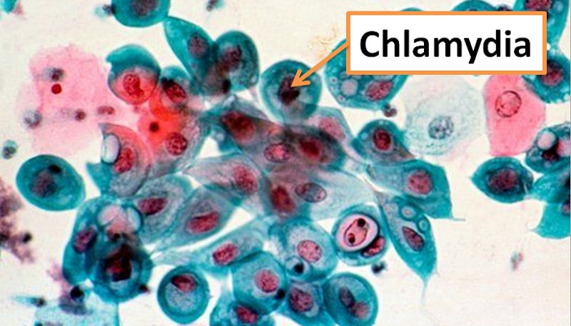 Phương pháp chẩn đoán bệnh Chlamydia chính xác